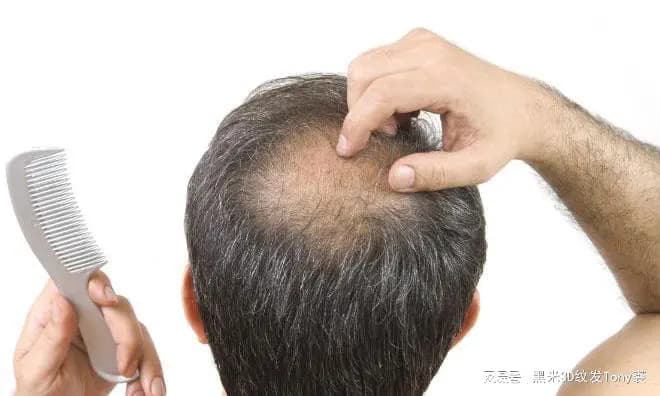 脱发怎么办？纹发与传统生发方法大比拼