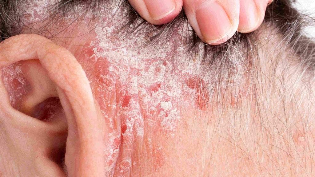 耳部牛皮癣：症状、原因、预防与治疗全解析
