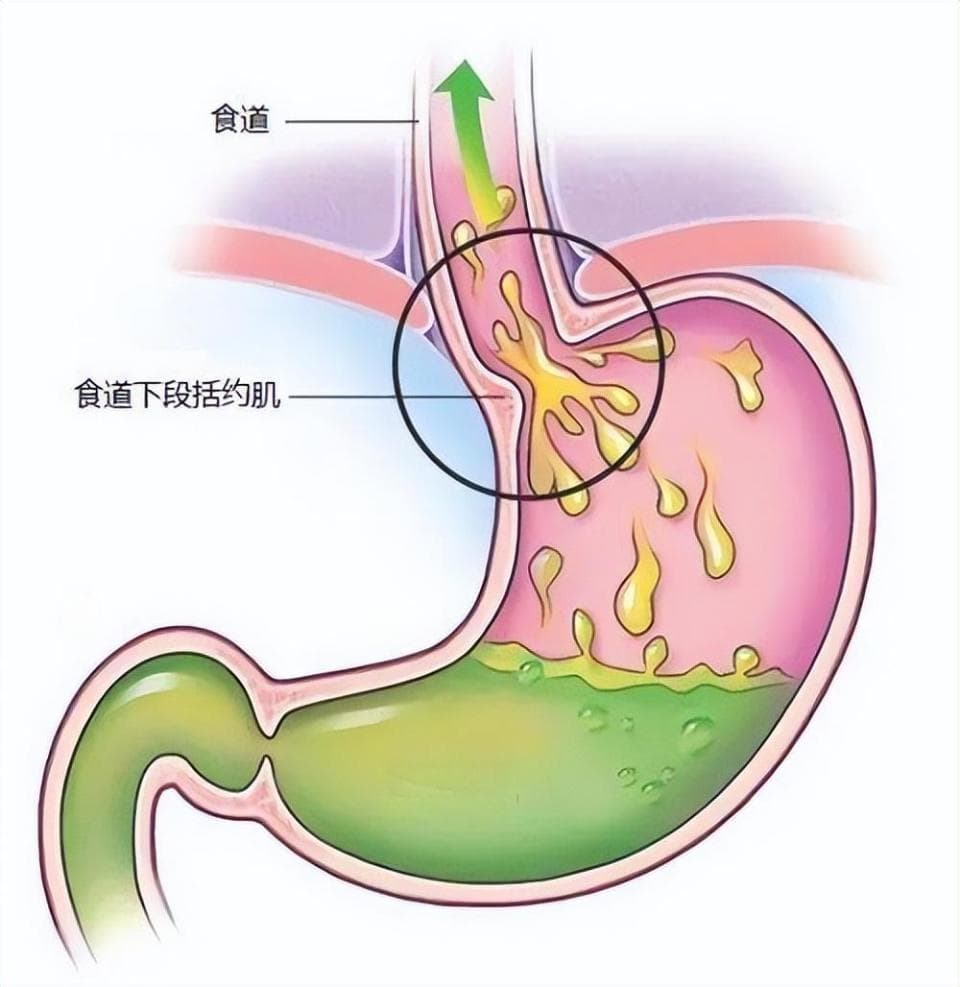 胃食管反流病：从"口吐酸水"到并发症，你需要知道这些