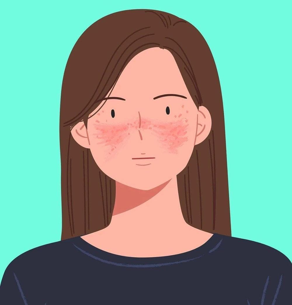 红斑狼疮是绝症吗？常规体检能否发现？一起了解→