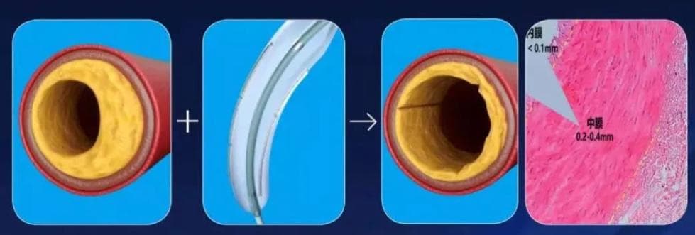 心血管介入治疗新突破：切割球囊刀片降低手术风险