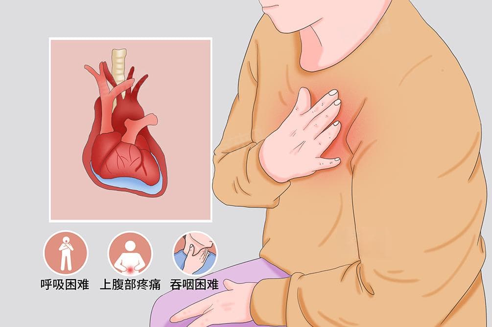 心包有少量积液需要治疗吗