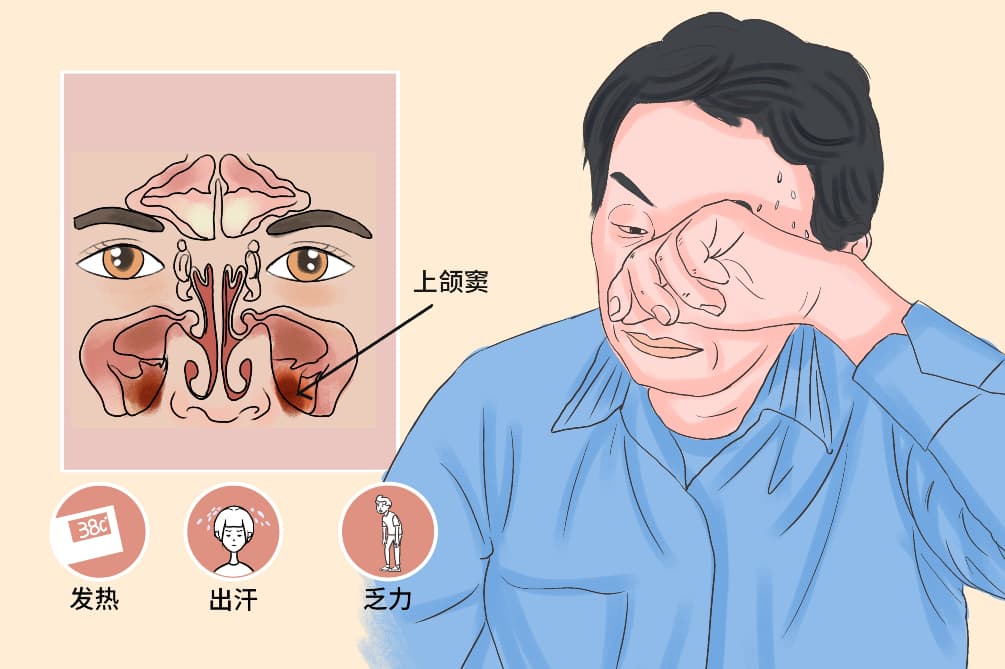 牙源性上颌窦炎：病因、症状与治疗全解析