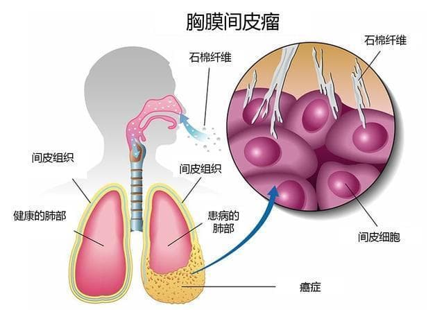 石棉瓦致癌，家中的石棉瓦必要裁撤吗？