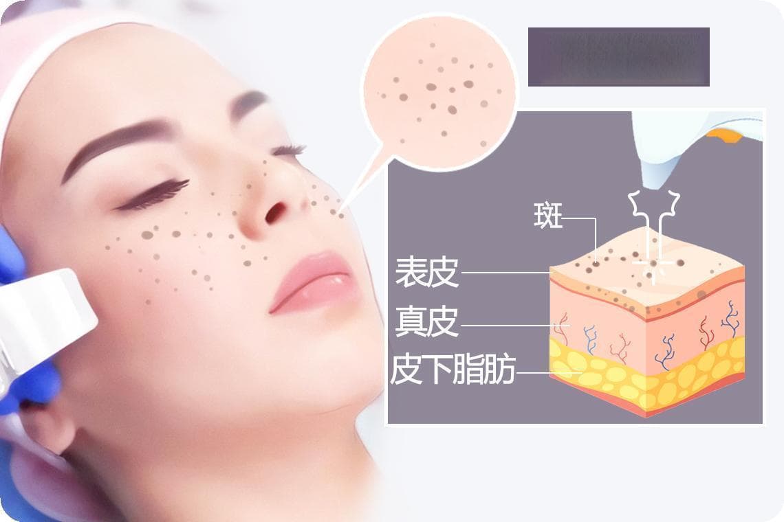 皮秒激光祛斑的注意事项