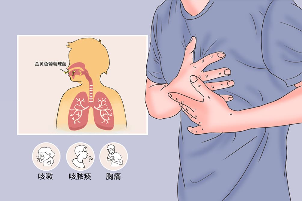 金黄色葡萄球菌肺炎