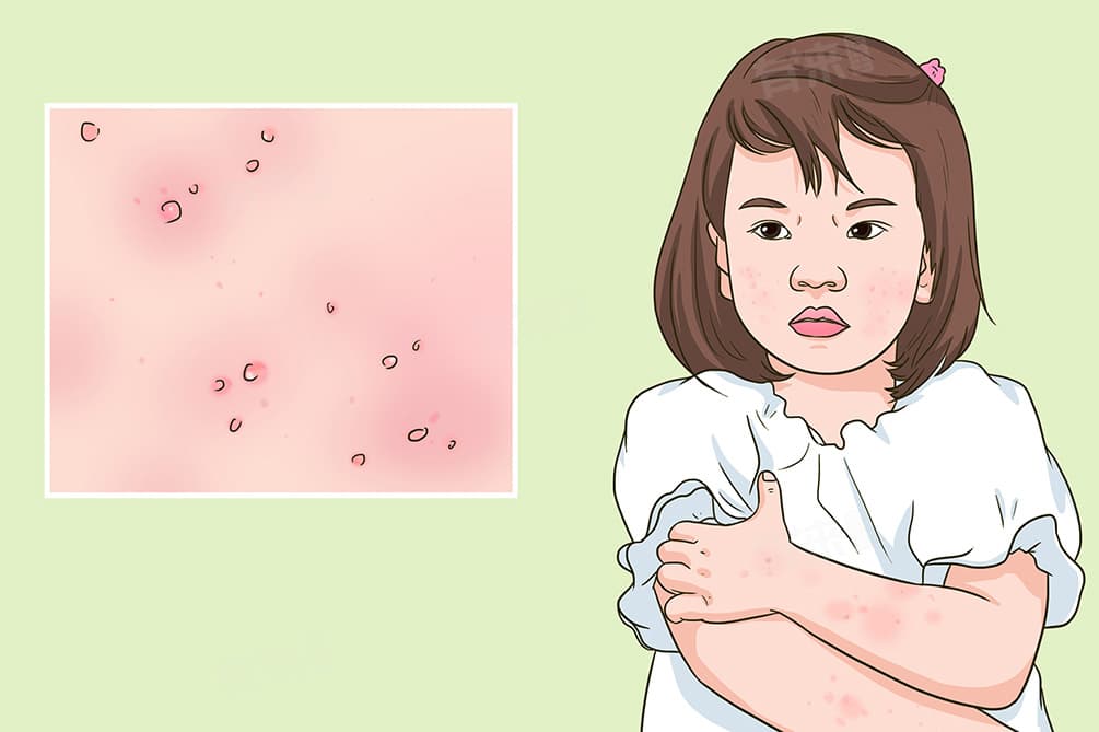 小孩过敏的原因、症状与预防措施