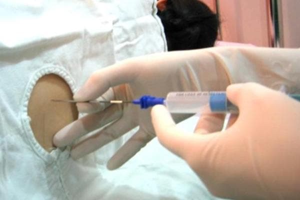 剖腹产手术过程详解及注意事项
