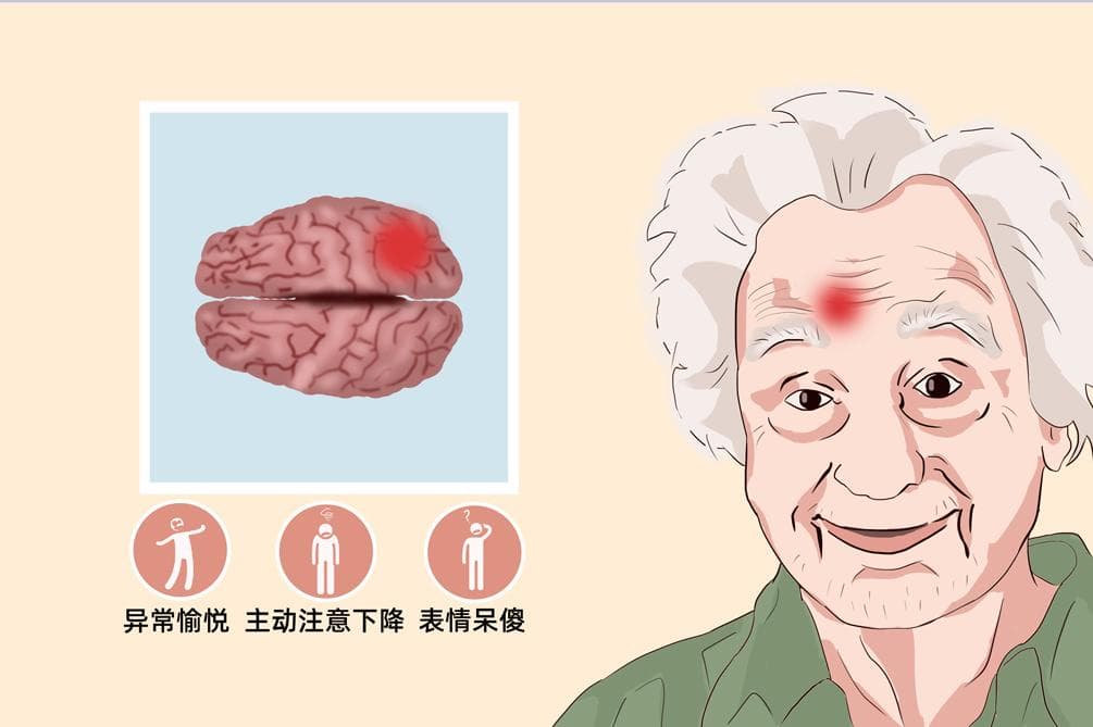 病态欣快感：症状、诊断与治疗全解析