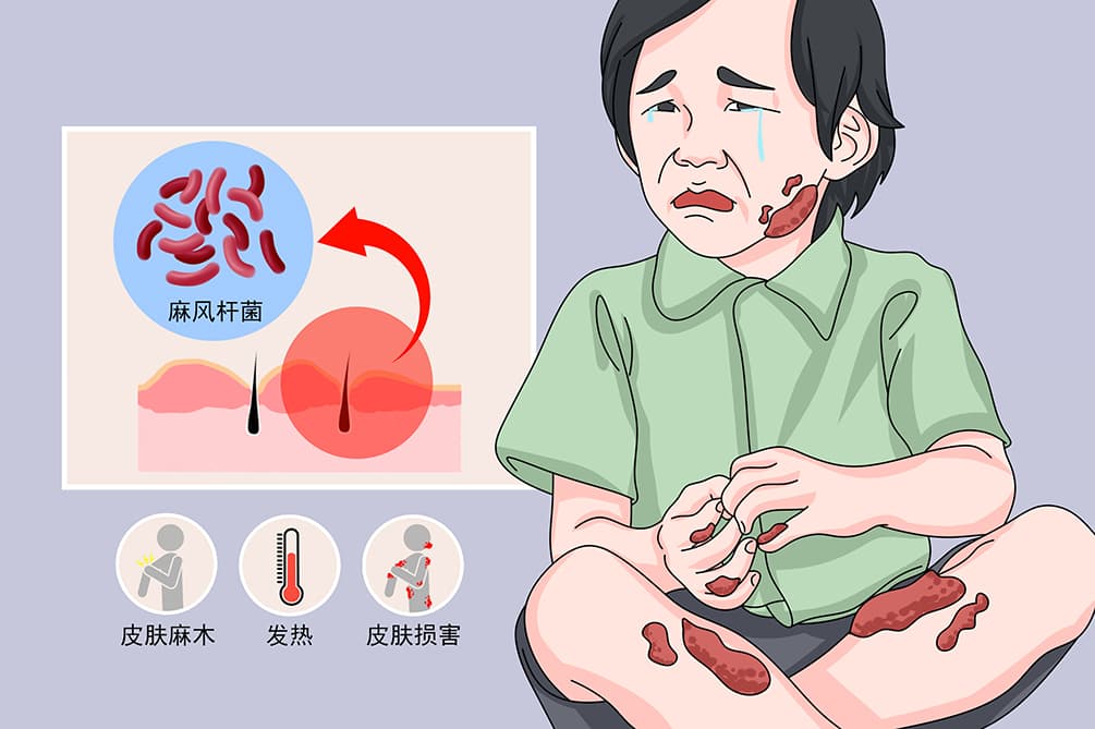 麻风病：病因、症状、诊断与治疗全解析