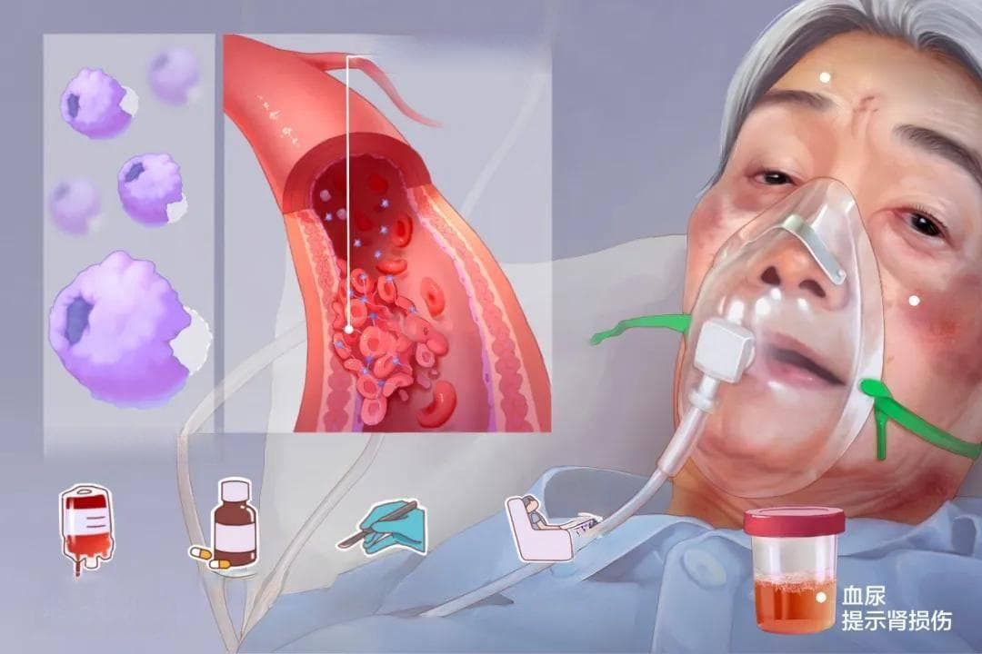血小板减少治疗指南：西医快速控制，中医注重调理