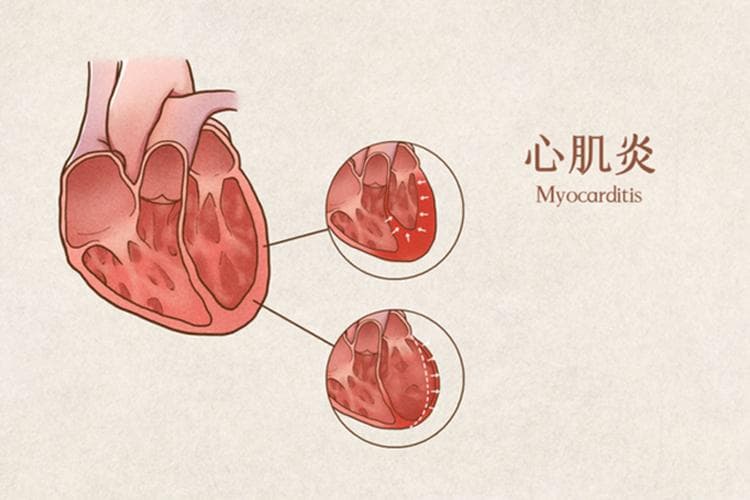 心肌炎检查