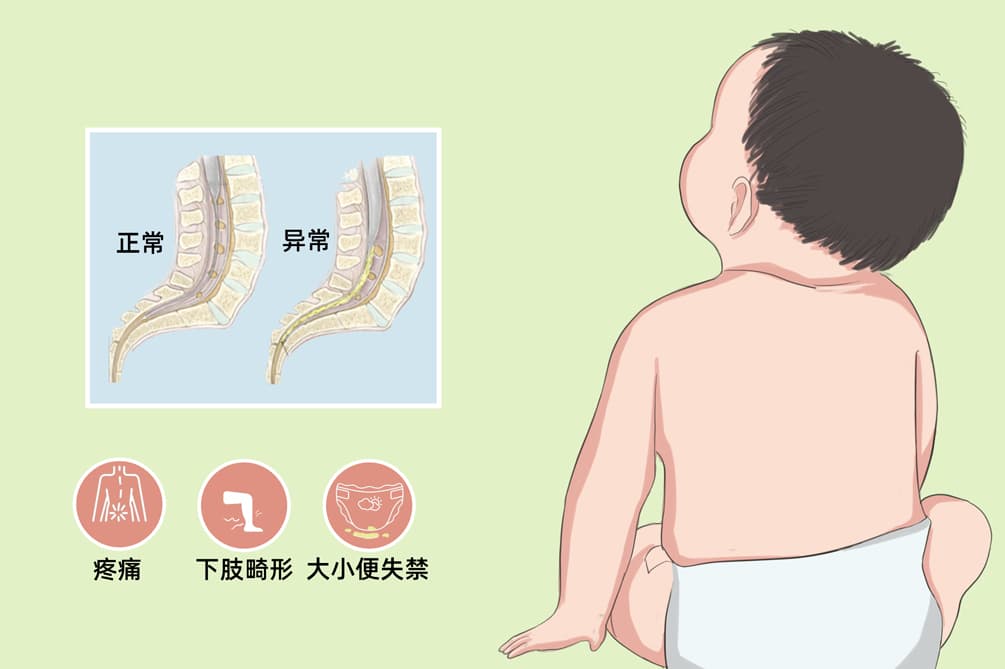 脊髓栓系综合征