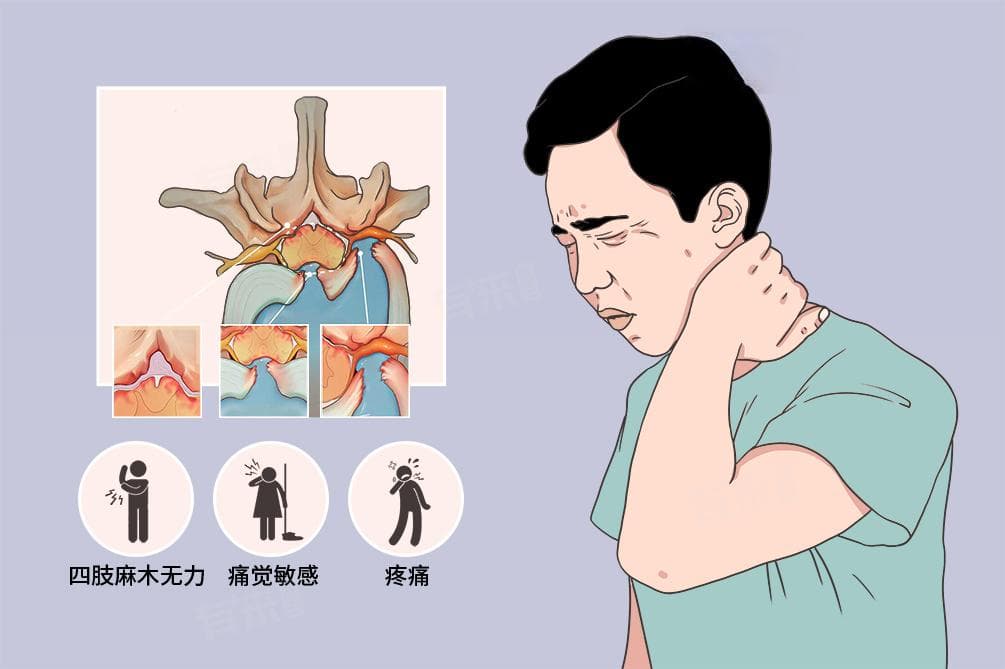 颈椎狭窄怎么治疗最好的方法