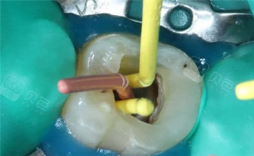 根管治疗中的守护者：橡皮障的神奇作用