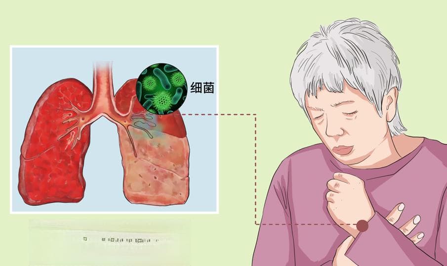 细菌性肺炎怎么治疗才能好得快