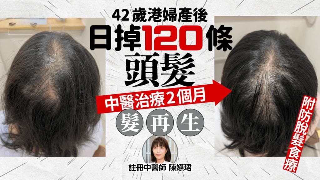 产后脱发怎么办？42岁港妇日掉120根头发，中医治疗2月后再生