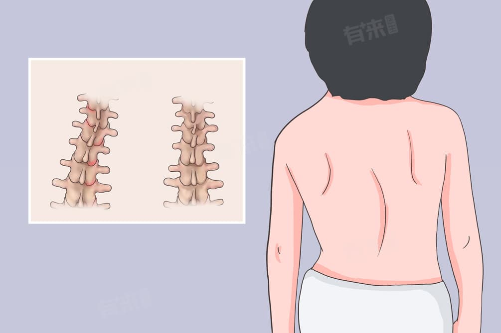 脊椎侧弯怎么自行矫正