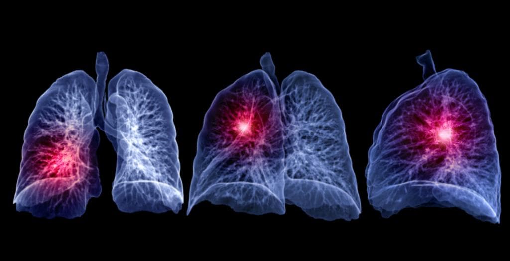 【肺癌宝典】实性结节、磨玻璃结节、混合型结节，哪个恶性风险更高？分别如何应对？