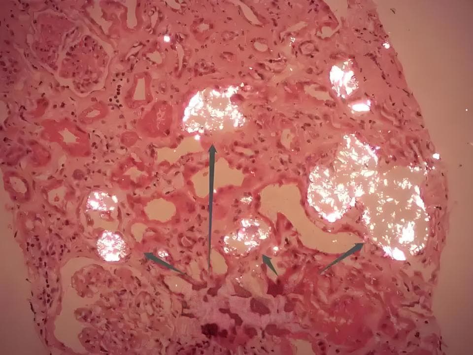 一天三顿炒辣椒竟致急性肾损伤？“草酸盐肾病”原因不那么单纯！