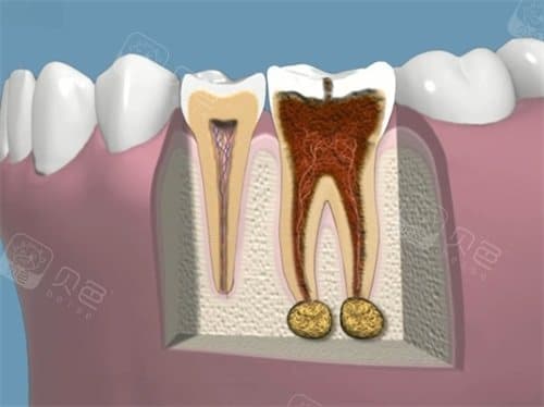 牙齿根管治疗就是个坑？深入分析根管治疗过程、必要性及潜在问题