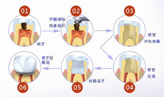 根管治疗后需要注意哪些问题？