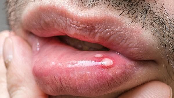 嘴唇肿胀不痛？揭开饮食习惯背后的健康真相！