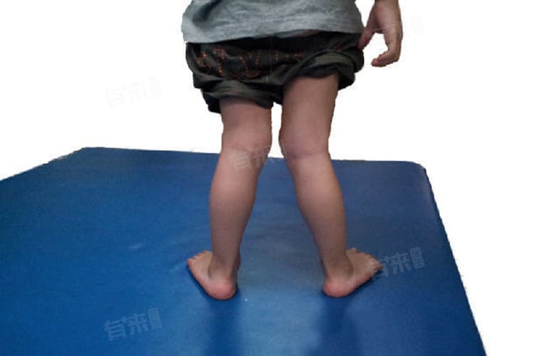 小腿外翻是什么原因