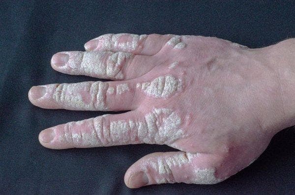 鼻炎用氯雷他定跟香菊胶囊