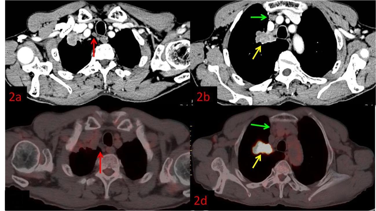 健康科普 | 发现肺癌，为什么要做PET/CT？