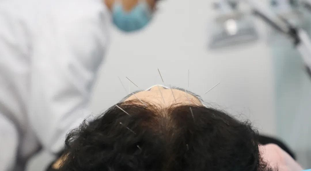 眼针疗法：以眼周取穴为主的独特中医治疗方法