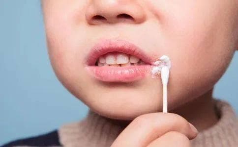 “烂嘴角”不只是上火！口角炎的成因、治疗与预防全解析