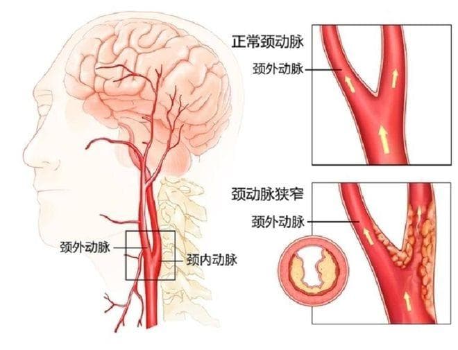 颈部血管彩超：预防脑血管疾病的“秘密武器”