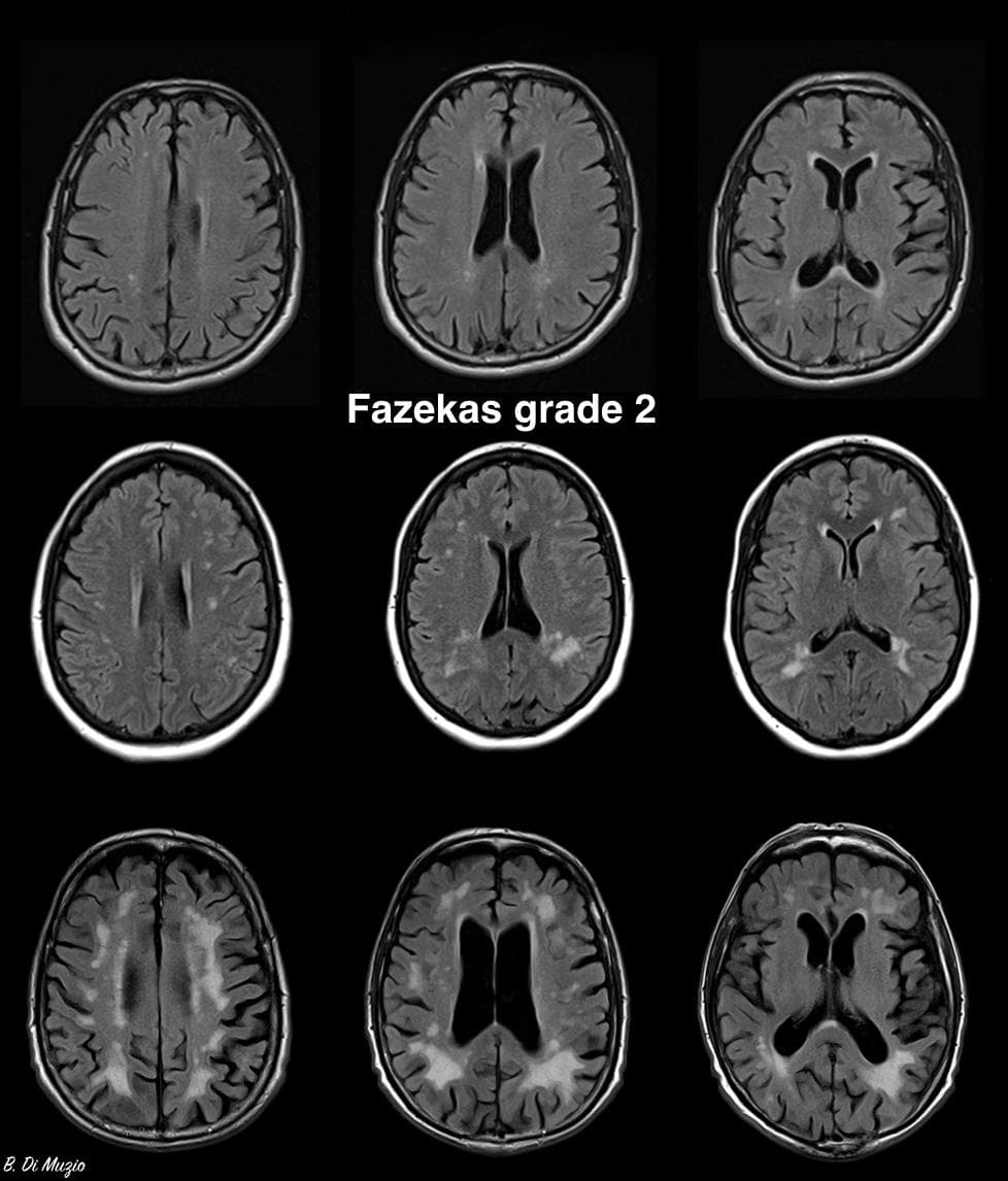 一文带您了解Fazekas分级！