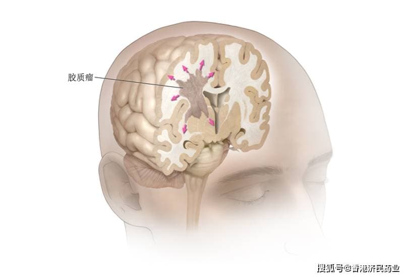 2级IDH突变型胶质瘤迎来首个靶向疗法！Voranigo已在美获批上市