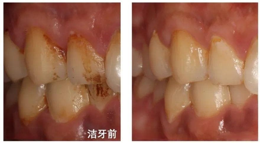 怎样拥有一口亮白美牙？华西口腔美牙秘籍请查收！