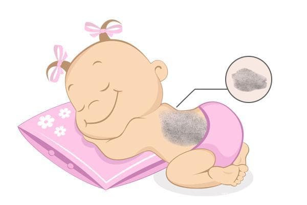 胎记对儿童心理健康的影响不容忽视，专家建议早发现早干预
