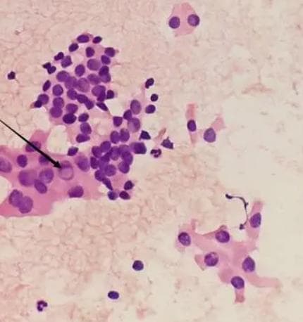 甲状腺结节细针穿刺：适应证、禁忌证及操作指南