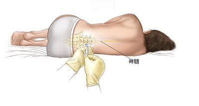 “腰穿”不可怕！神经外科于新主任带你科学认识腰椎穿刺术