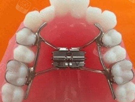 正畸扩弓对脸型的影响：颌骨宽度、面部轮廓与咬合关系的全面解析