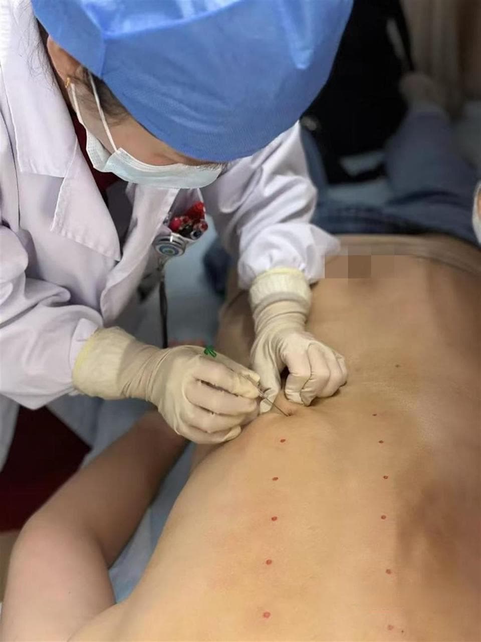 “线”到病除：60厘米线让哮喘患者呼吸更自由