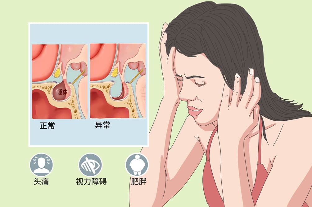 空蝶鞍综合征