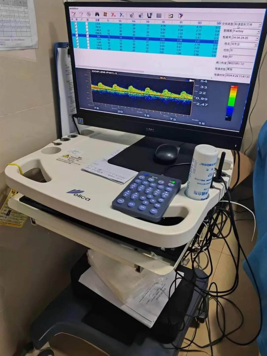 TCD发泡试验——探寻不明原因的头晕、头痛