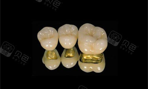 什么假牙牙套材质用的时间久？分析多种材料假牙牙套看哪个更适合自己~