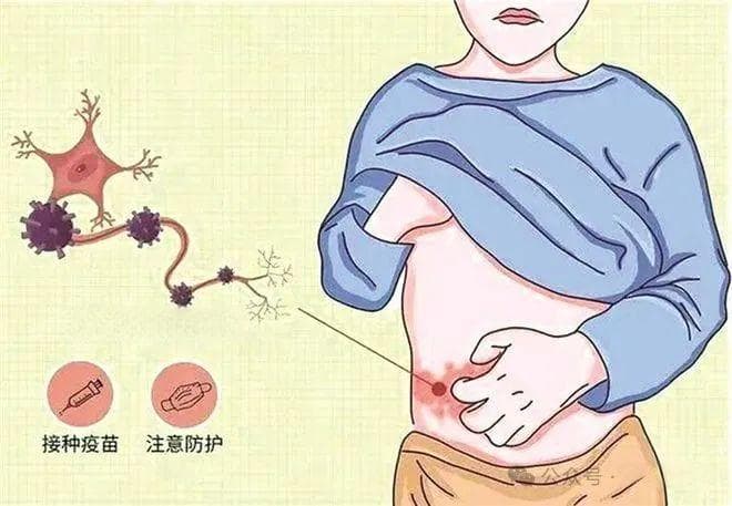 “缠人”的带状疱疹