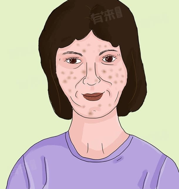 黄褐斑和雀斑的区别