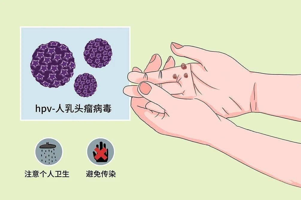 【健康科普】带你认识寻常疣 寻常疣的成因与症状