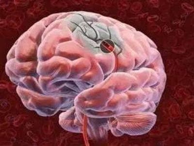 浙里康养科普：偏瘫患者如何克服行走困难，提高步行能力