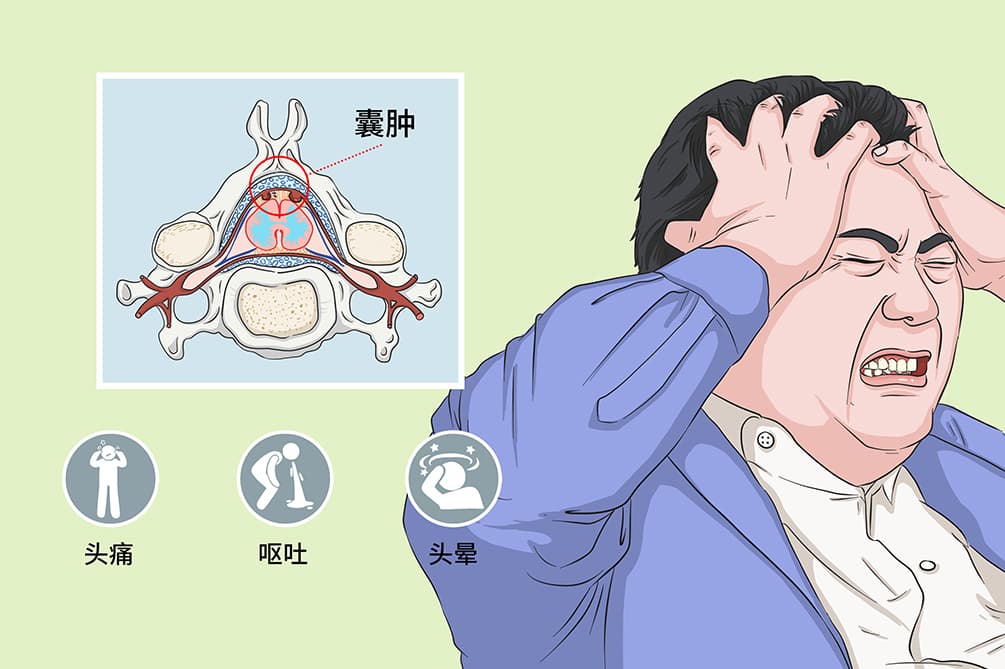 蛛网膜囊肿