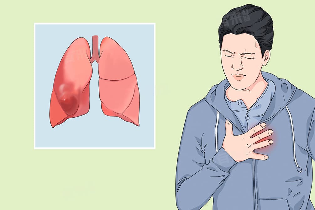 肺大泡的主要症状是什么